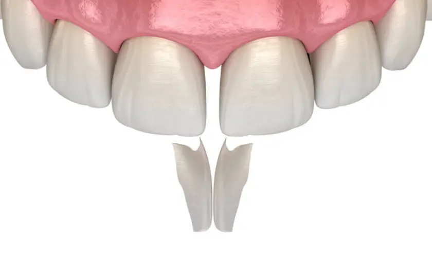 Do You Need Dental Bonding From Your Dentist in West Palm Beach, FL?