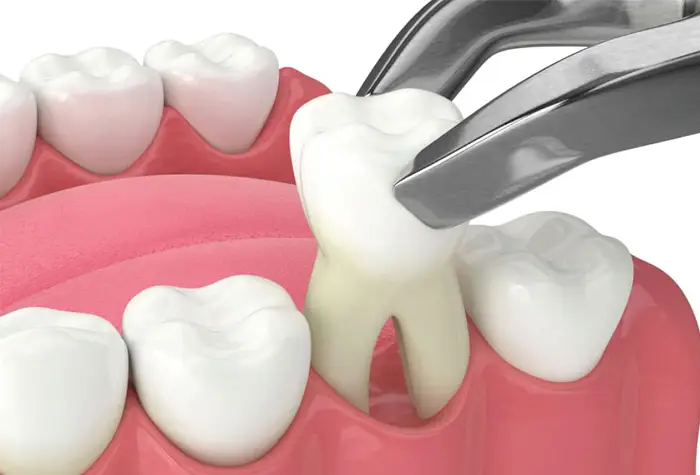 Blue Jay Family Dentistry | Tooth Extraction