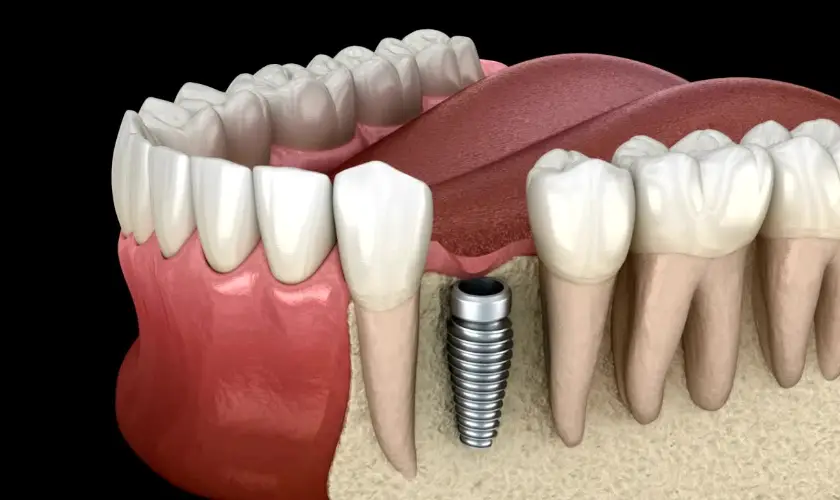 Blue Jay Family Dentistry | How Dental Implants Can Improve Your Quality of Life