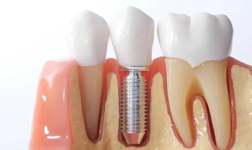 Understanding the Benefits of Dental Implants