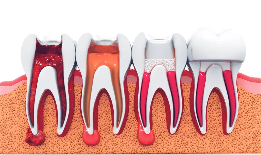 Blue Jay Family Dentistry | Understanding Root Canal Therapy in Children