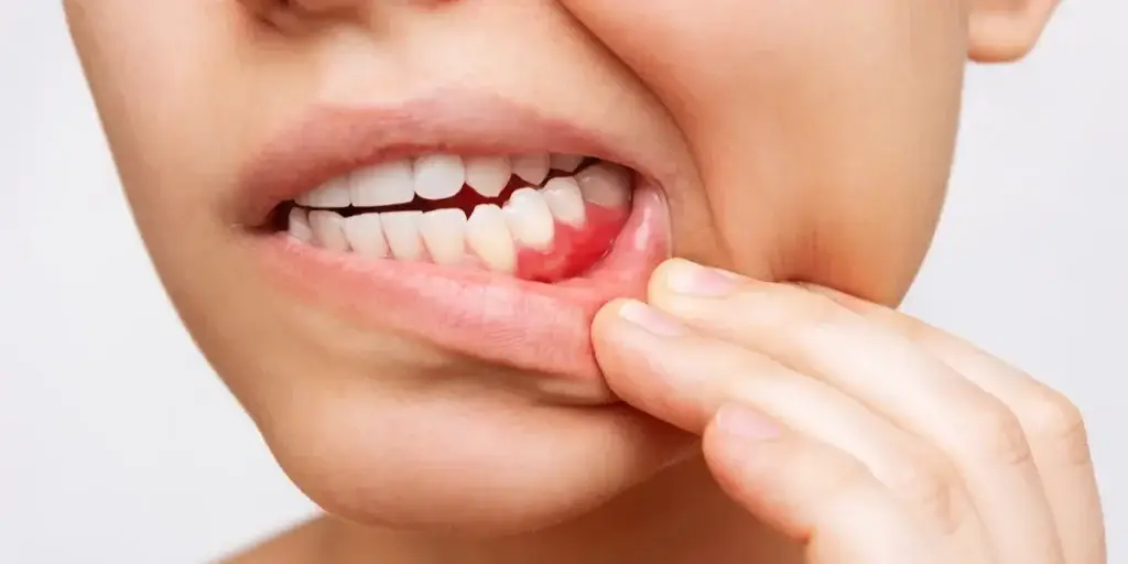 gum disease prevention