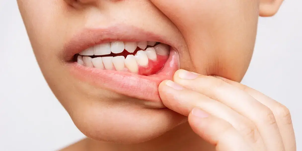 gum disease prevention