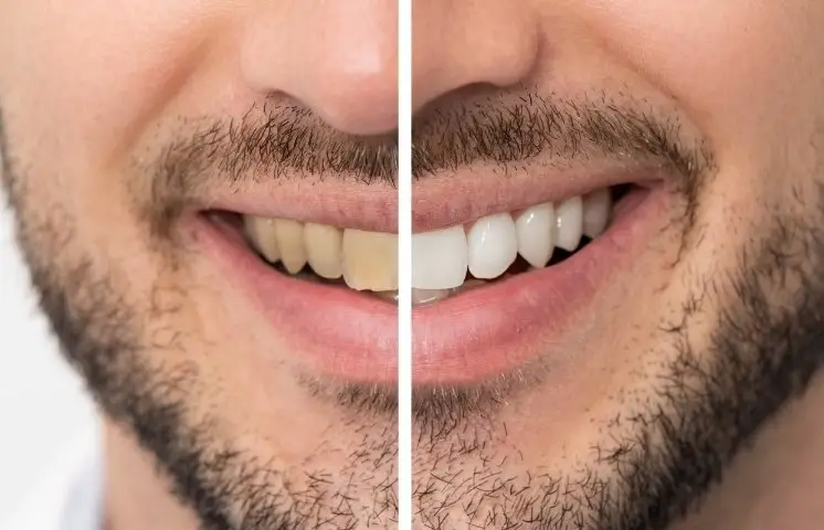 the hottest teeth whitening trends for Christmas 2024