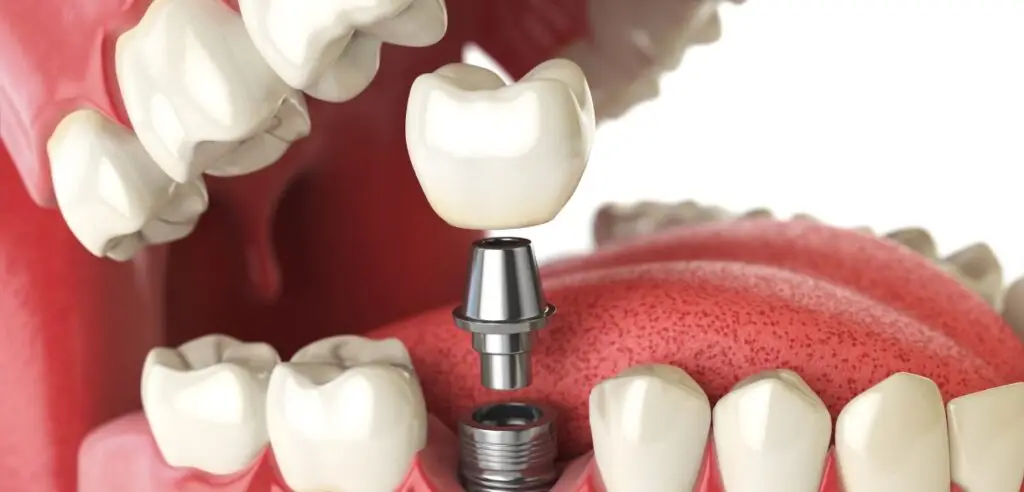 Dental implant and natural tooth comparison Dental implant and natural tooth comparison