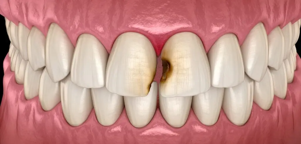 Tooth Abscess Emergency: Symptoms, Risks & When to Seek Help