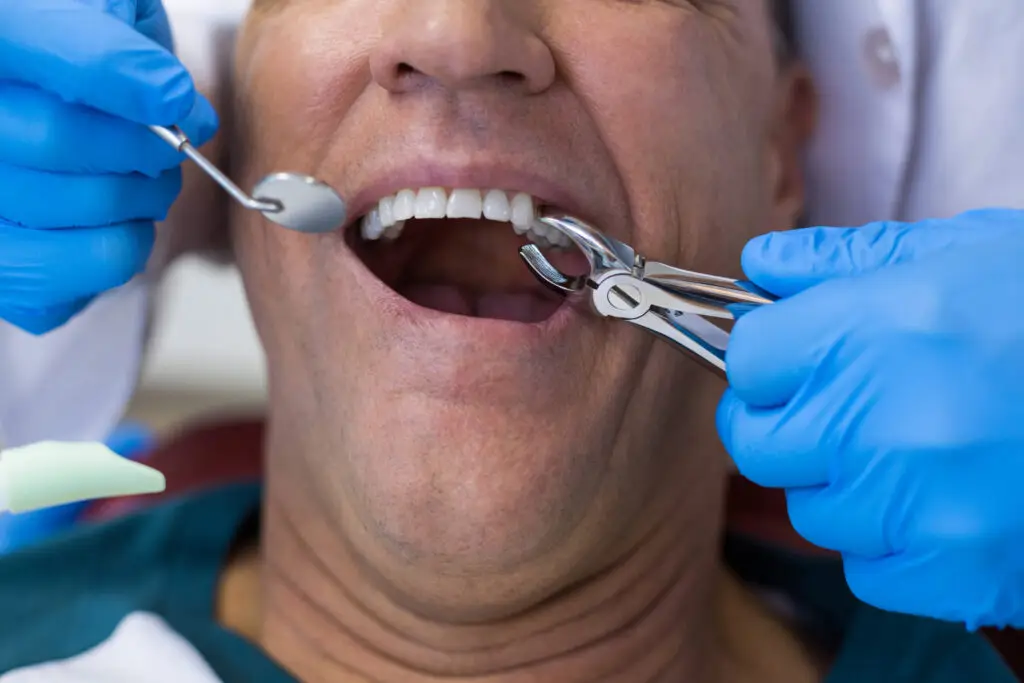 Illustration of dry socket after tooth extraction Illustration of dry socket after tooth extraction