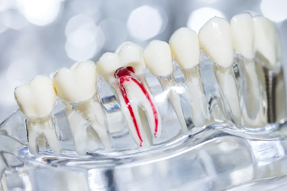 Blue Jay Family Dentistry | How to Prepare for a Root Canal in West Palm Beach?