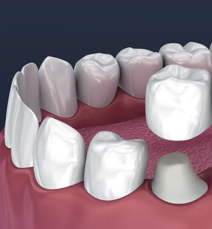 Blue Jay Family Dentistry | Dental Crowns