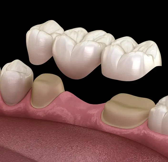 Blue Jay Family Dentistry | Dental Bridges