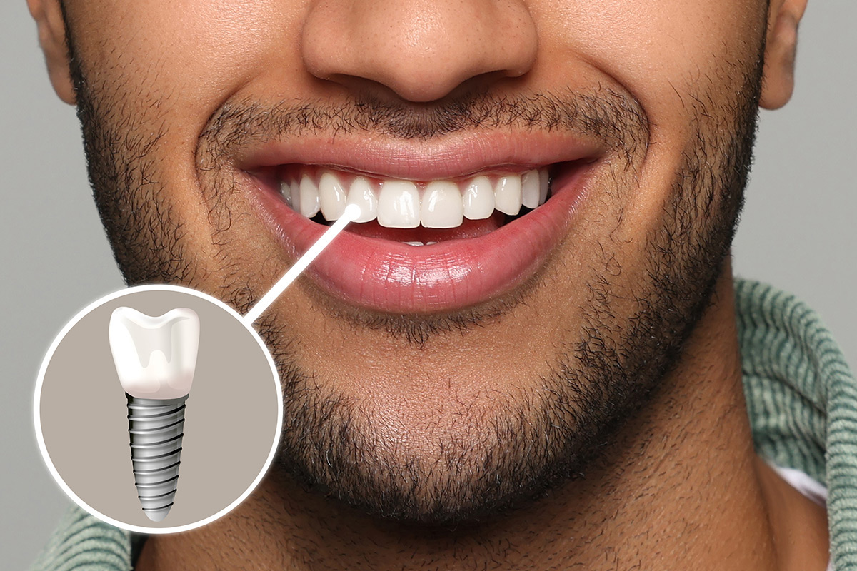 Blue Jay Family Dentistry | Dental Implants