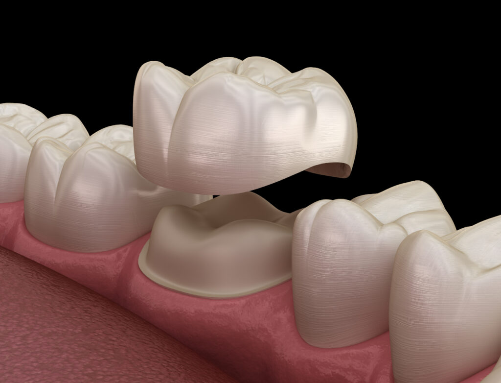 Dental Crowns in Maplewood, MN: When Is a Crown Better Than a Filling?