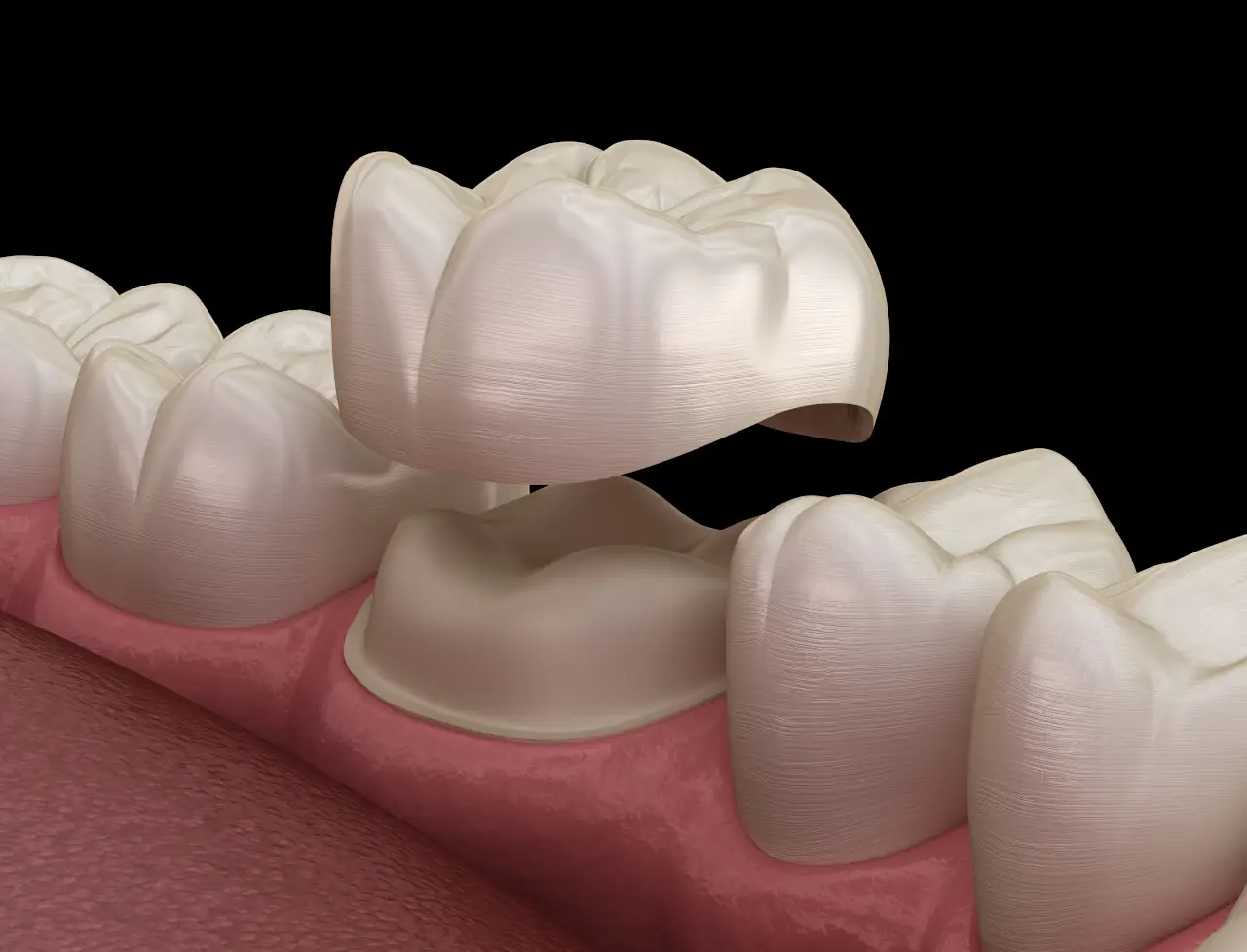 Dental Crowns in Maplewood, MN: When Is a Crown Better Than a Filling?